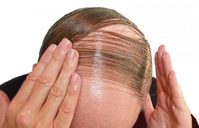 درمان خانگی ریزش مو در نوجوانی |درمان ریزش مو در نوجوانی پسران