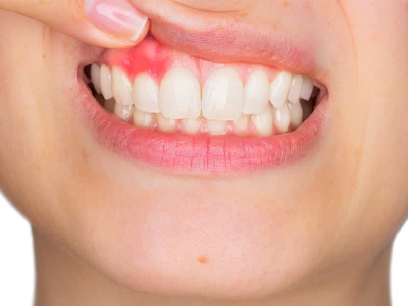 علائم سرطان دندان
