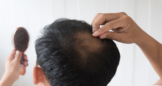 Home treatment for severe hair loss in men