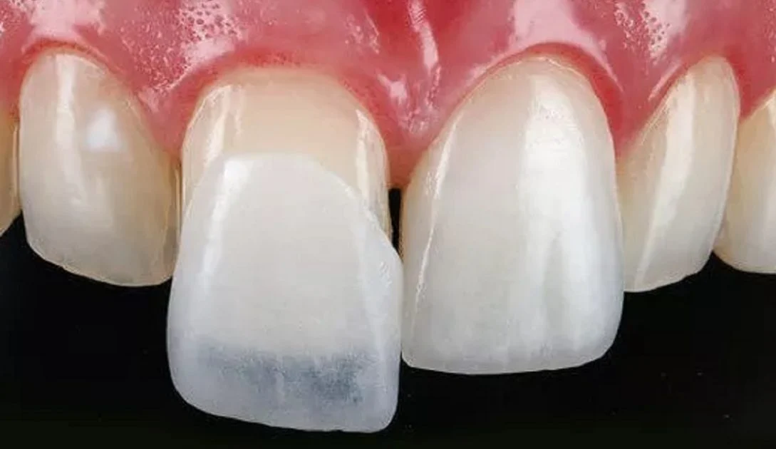 Does-dental-laminate-cause-bad-breath