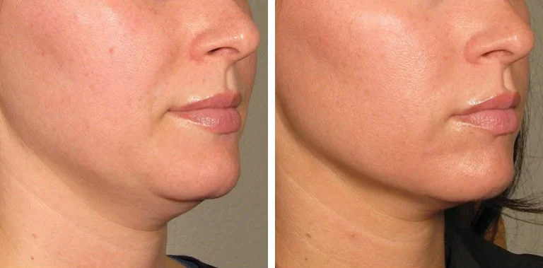 مزوتراپی مزوتراپی صورت چگونه است