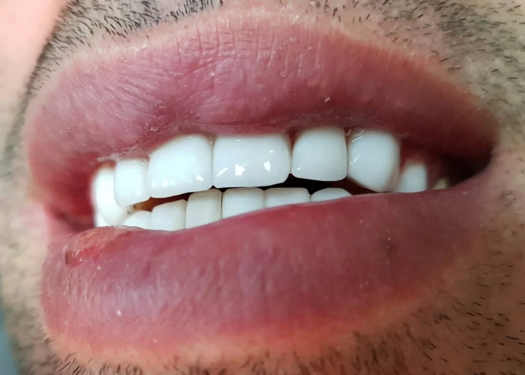 لمینت دندان