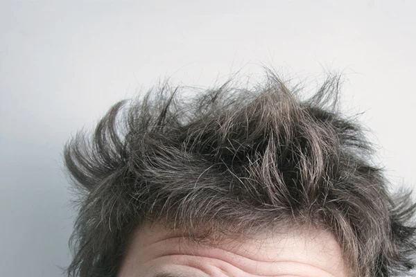 Drug treatment of hormonal hair loss