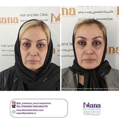 قبل و بعد جراحی پلک