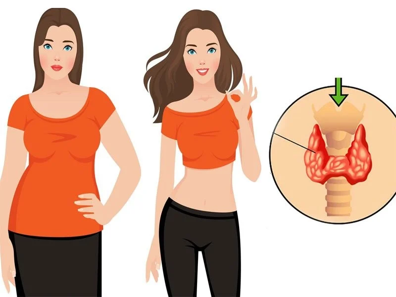 بیماری |چاقی آیا بیماری های تیروئید باعث چاقی می شوند؟